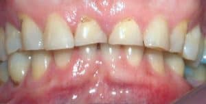 Tooth Wear or Bruxism