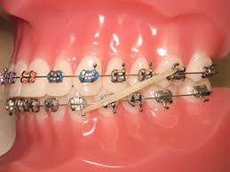 where can i get rubber bands for braces